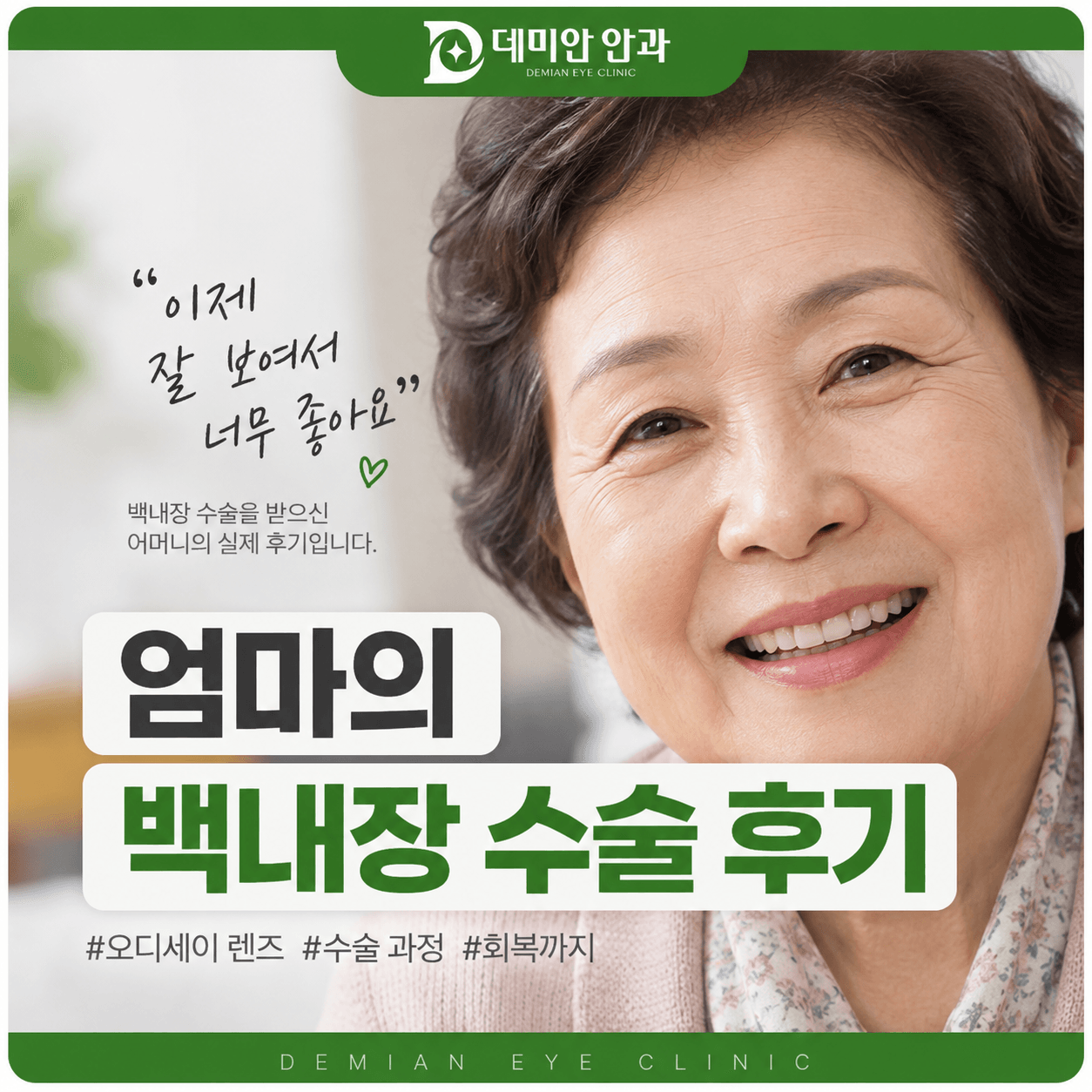 엄마가 직접 받은 노안백내장 수술, 오디세이 렌즈 후기