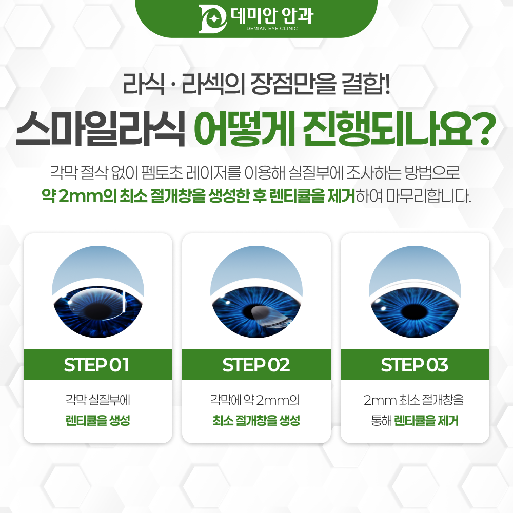 스마일라식 수술 과정 단계별 안내 이미지